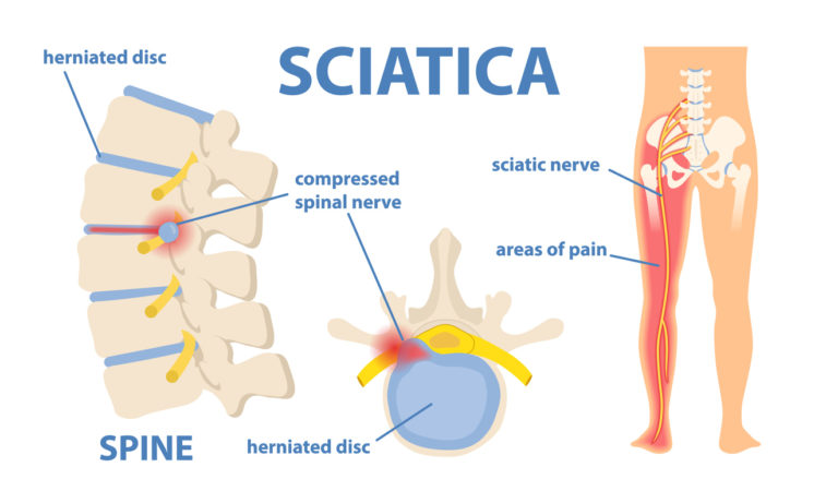 Sciatica – A pain in the back side!